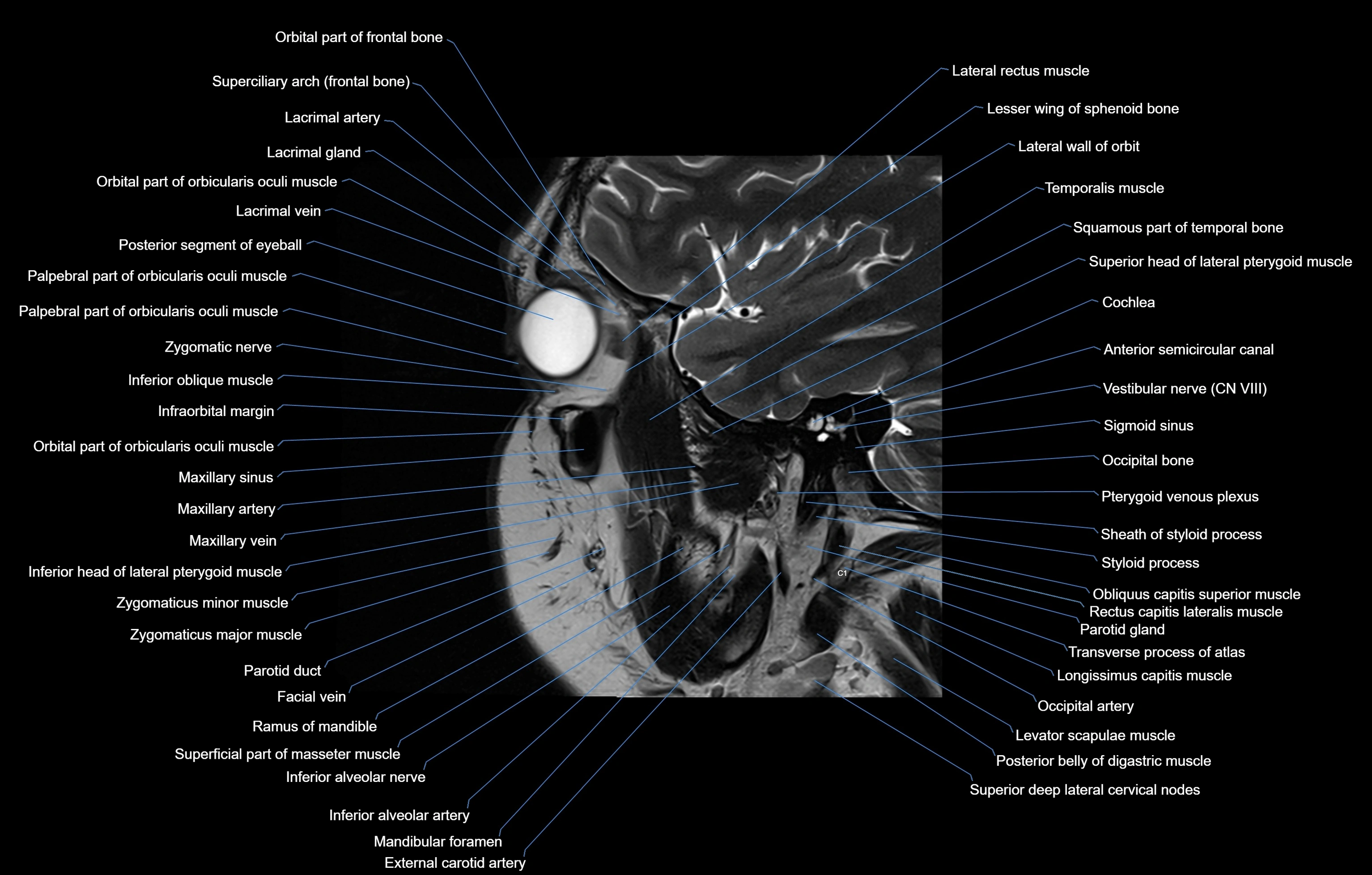 paranasal sinuses(PNS) MRI coronal  cross sectional anatomy 3T radiology  image-img-00001-00016.webp